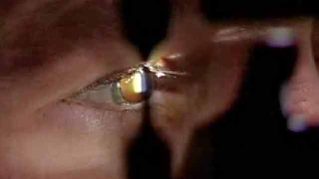 Advanced Corneal Systems